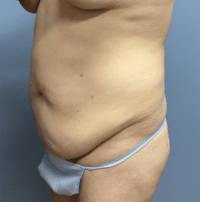 Tummy Tuck