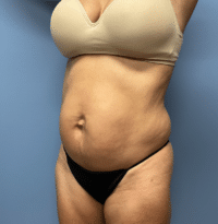 Tummy Tuck