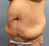 Tummy Tuck