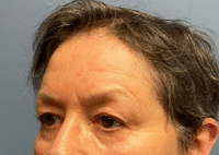 Brow Lift