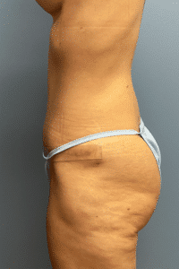 Tummy Tuck