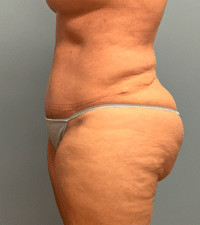 Tummy Tuck