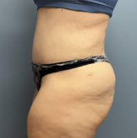 Tummy Tuck