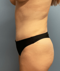 Tummy Tuck