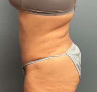 Tummy Tuck