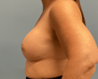 Breast Augmentation
