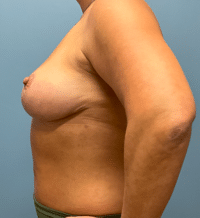 Breast Lift