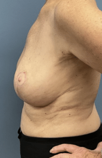 Breast Lift