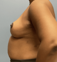 Breast Lift