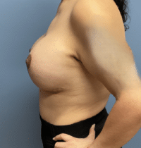 Breast Lift with Augmentation