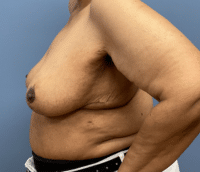 Breast Reduction