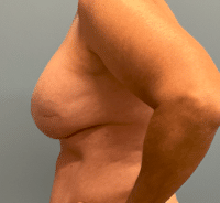 Revision Reconstruction