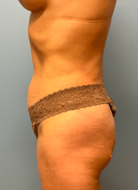 Liposuction