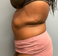 Panniculectomy