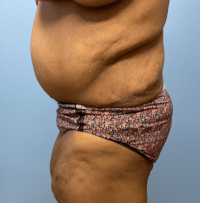 Panniculectomy
