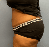 Tummy Tuck