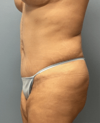 Tummy Tuck