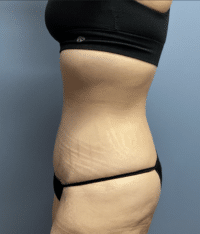 Tummy Tuck