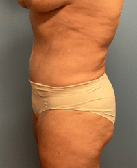Tummy Tuck