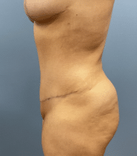 Tummy Tuck