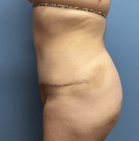 Tummy Tuck