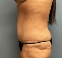 Tummy Tuck