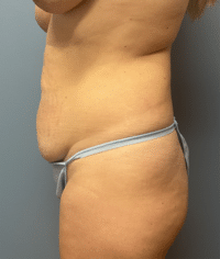 Tummy Tuck
