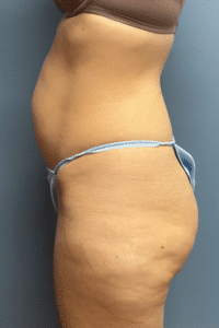 Tummy Tuck