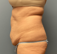 Tummy Tuck