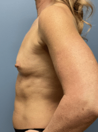 Breast Augmentation