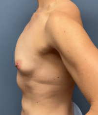 Breast Augmentation