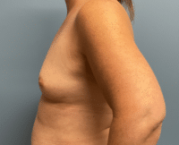 Breast Augmentation