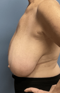 Breast Lift
