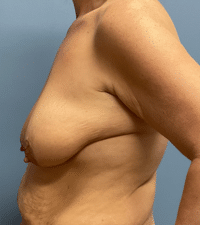 Breast Lift with Augmentation