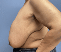 Breast Reduction
