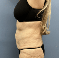 Circumferential Body Lift