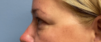 Eyelid Surgery