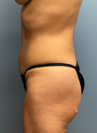 Liposuction