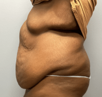 Panniculectomy