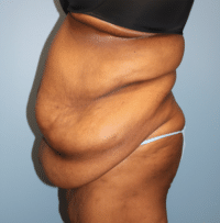 Panniculectomy