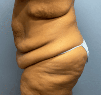 Tummy Tuck