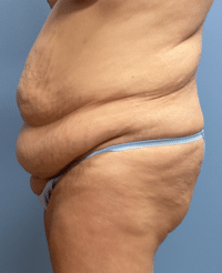 Tummy Tuck