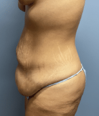 Tummy Tuck