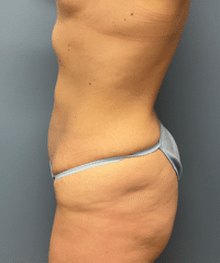 Tummy Tuck