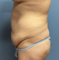 Tummy Tuck