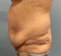Tummy Tuck
