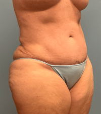 Tummy Tuck