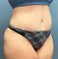 Tummy Tuck