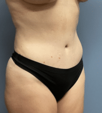 Tummy Tuck