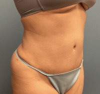 Tummy Tuck